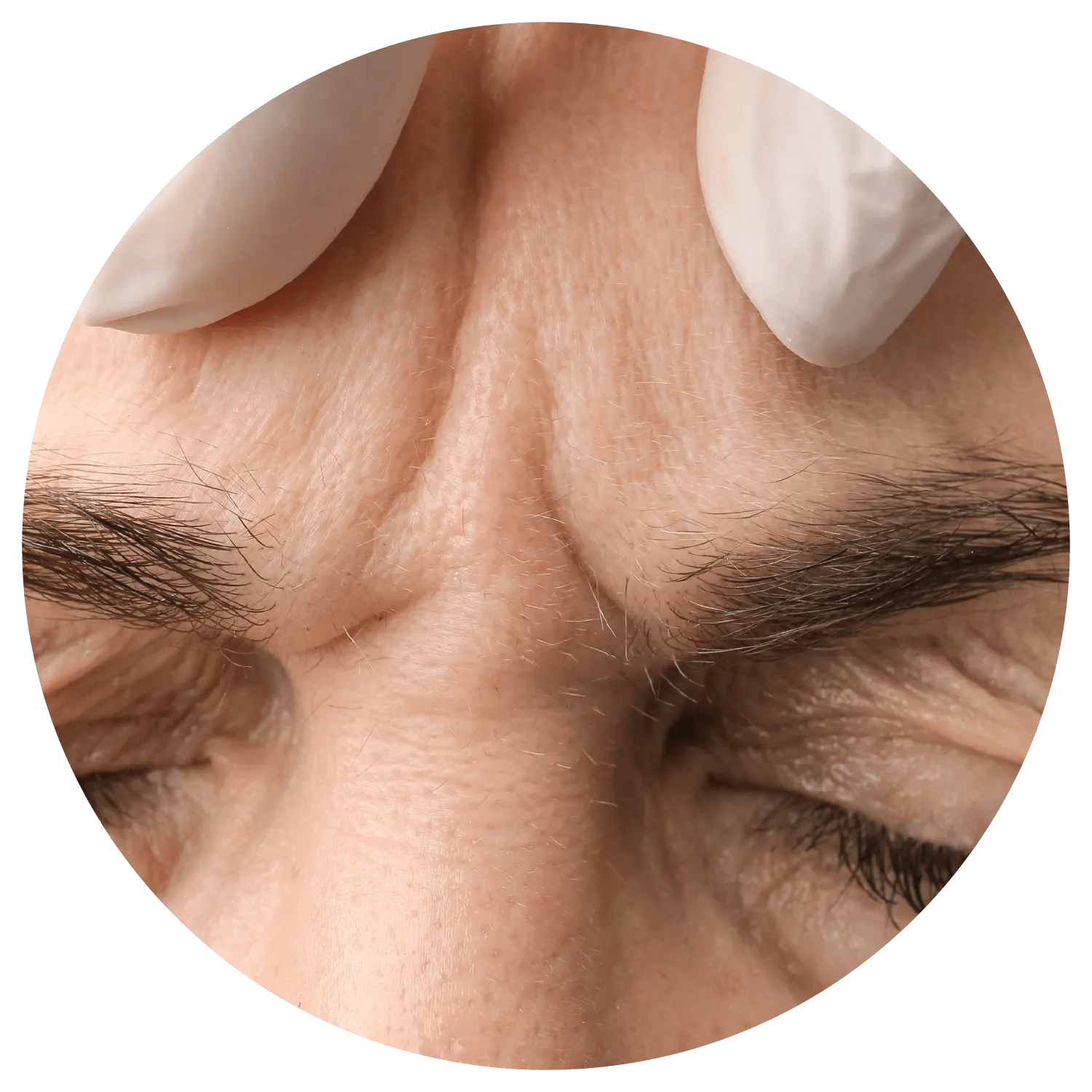 Glabellar lines treatment process at Toronto medical spa - root causes and development